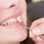 Dental Veneers