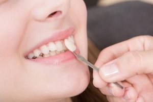 Dental Veneers