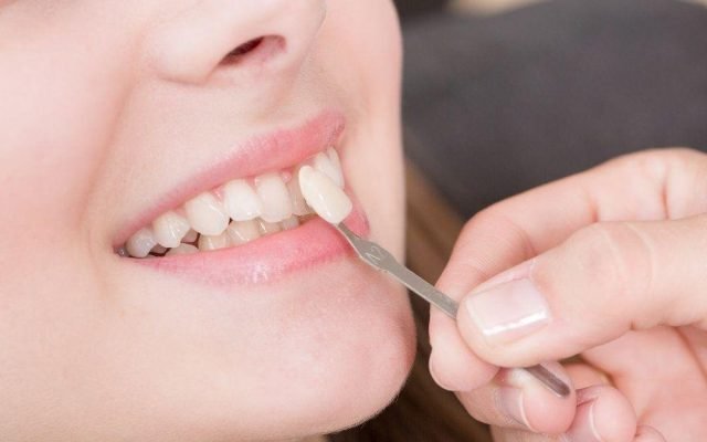 Dental Veneers